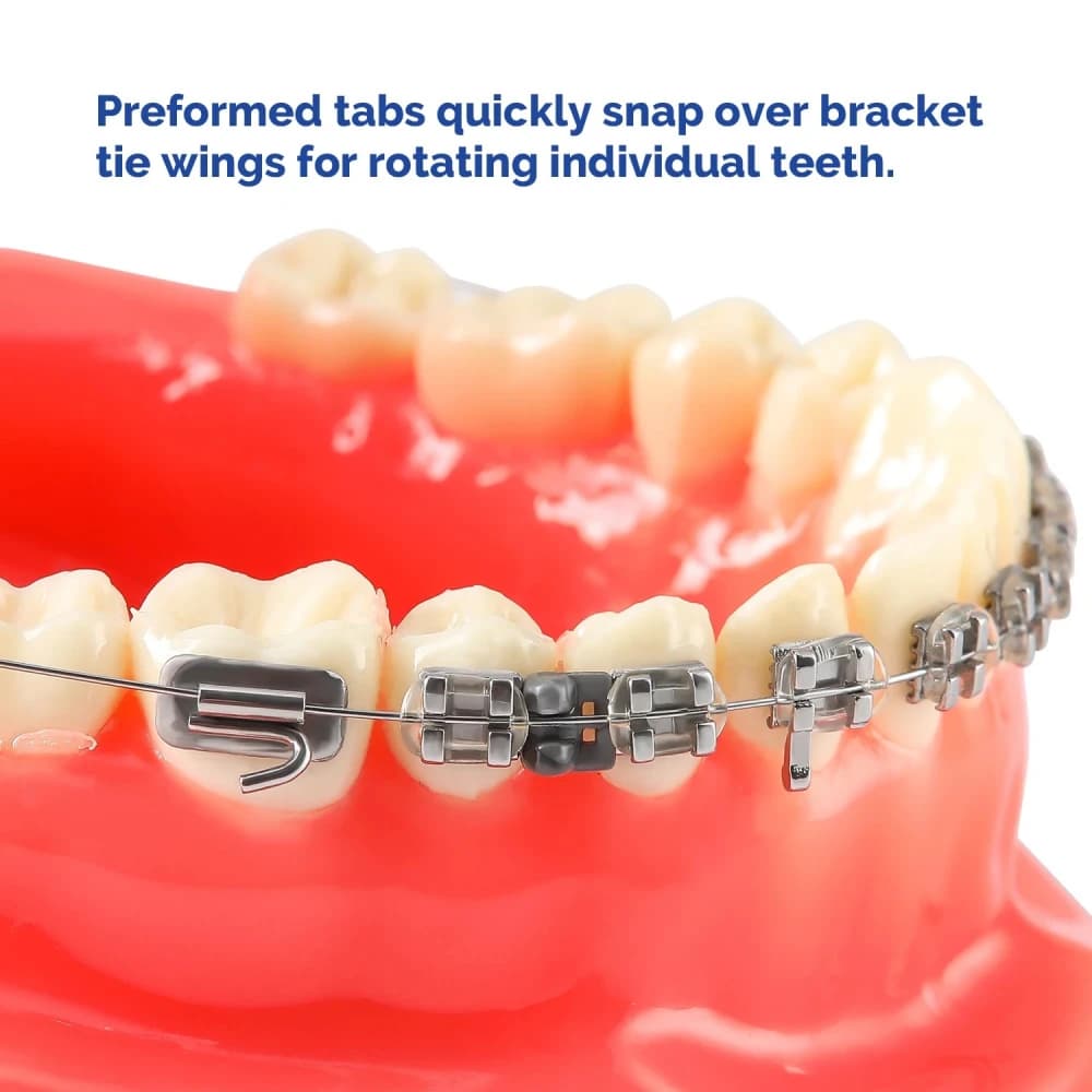 Gray orthodontic rotation wedge positioned between brackets on a dental model