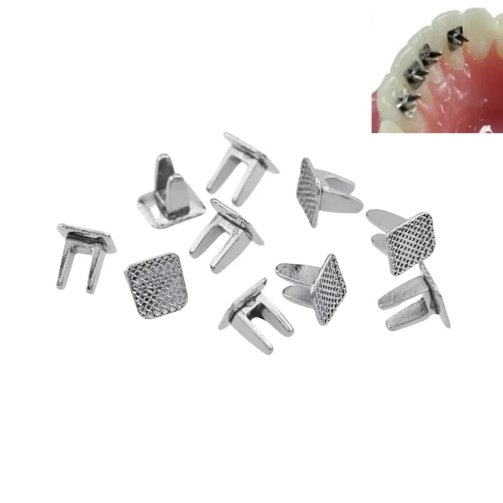 Stainless steel orthodontic tongue spurs in multiple views with a lingual placement example